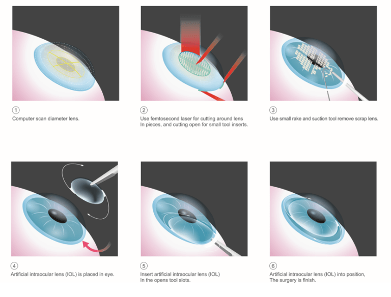 Cataract Surgery Technology Skyline Vision 2022 Skyline Vision 2022