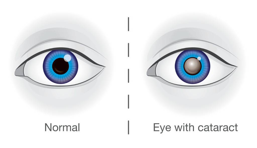 Normal Eye and Eye with a cataract