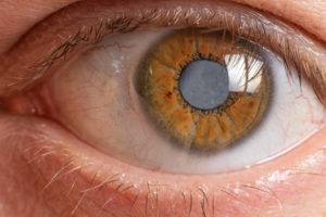 What Happens If You Have Glaucoma? featured image