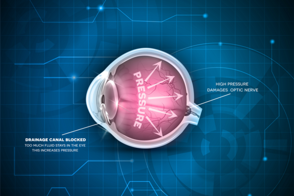 Can Glaucoma Be Stopped? featured image