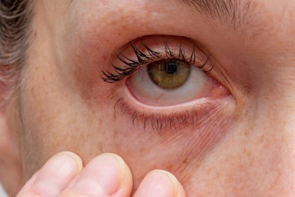 Uveitis Explained: Symptoms, Causes, and Why It’s a Medical Emergency featured image